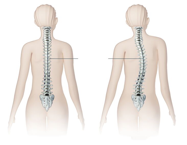 healthy and sick spine
