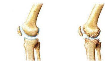 Symptoms of the knee base -atrocysis