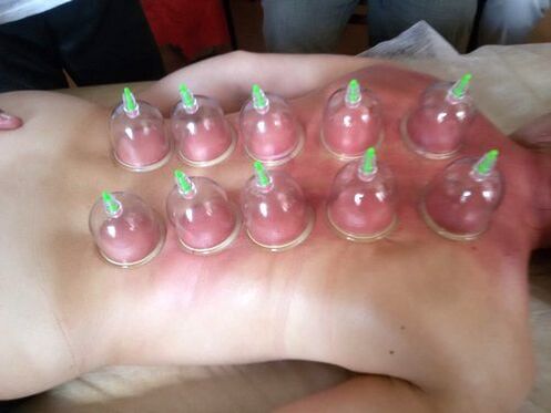 Vacuum cupping is an excellent way to treat back pain at home