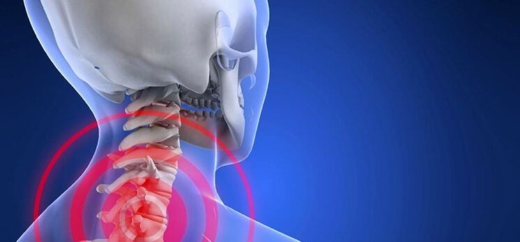 Osteochondrosis of the cervical spine